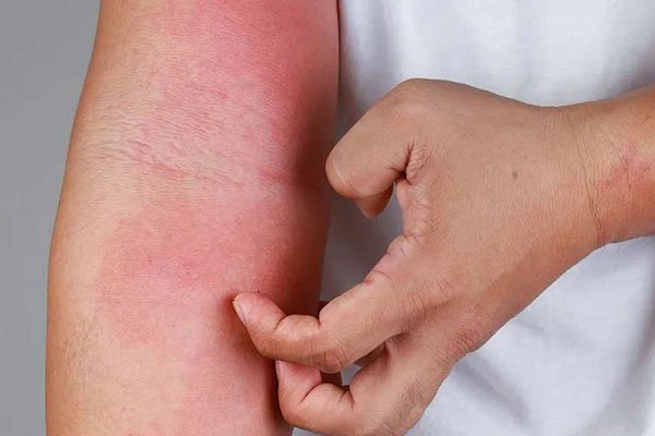 alergia na pele