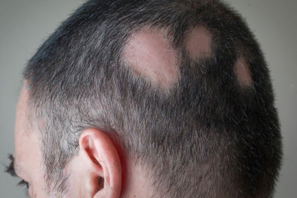 queda de cabelo (alopecia)