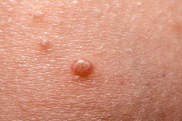 molusco contagioso
