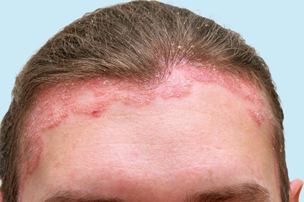 dermatite seborreica