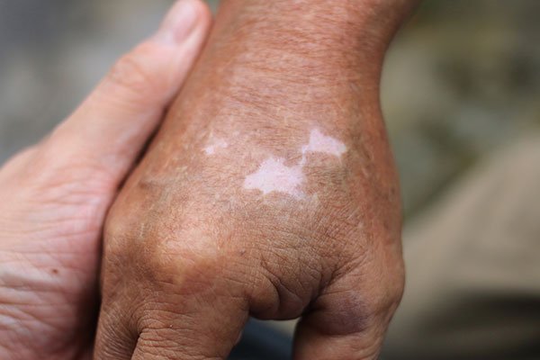 vitiligo